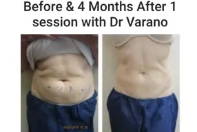 Before and after Coolsculpting abdome treatment by Medical Cosmetic Enhancements in Washington DC